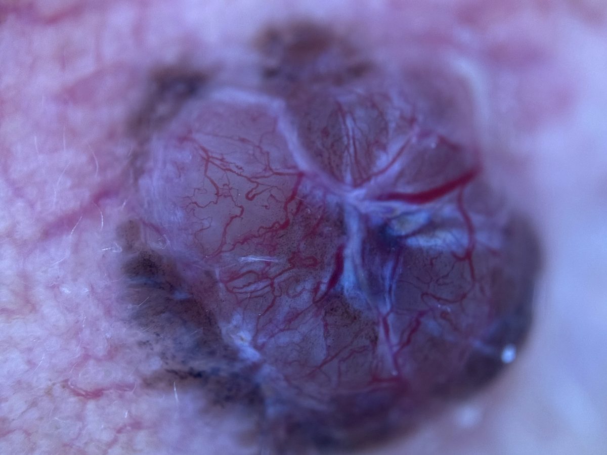 Imagem de dermatoscopia de um carcinoma basocelular, com vasos vermelhos ramificados sobre a lesão