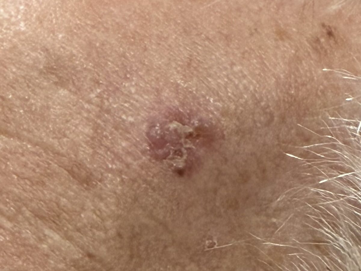 Carcinoma basocelular na região temporal esquerda: lesão rosada, com crosta na superfície, em pele com sinais de sol acumulado