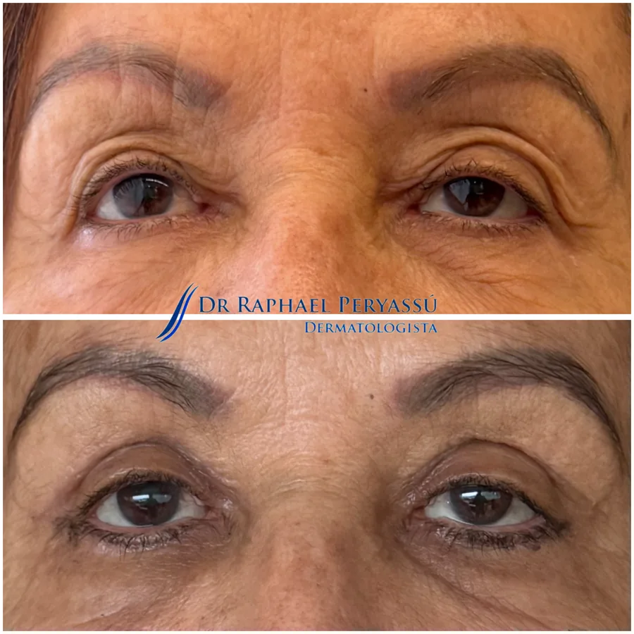 Blefaroplastia antes e depois – Caso 1