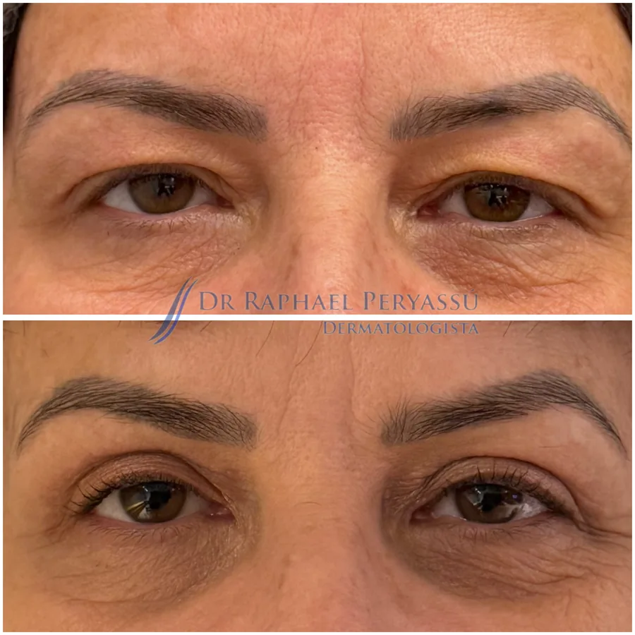Blefaroplastia antes e depois – Caso 2