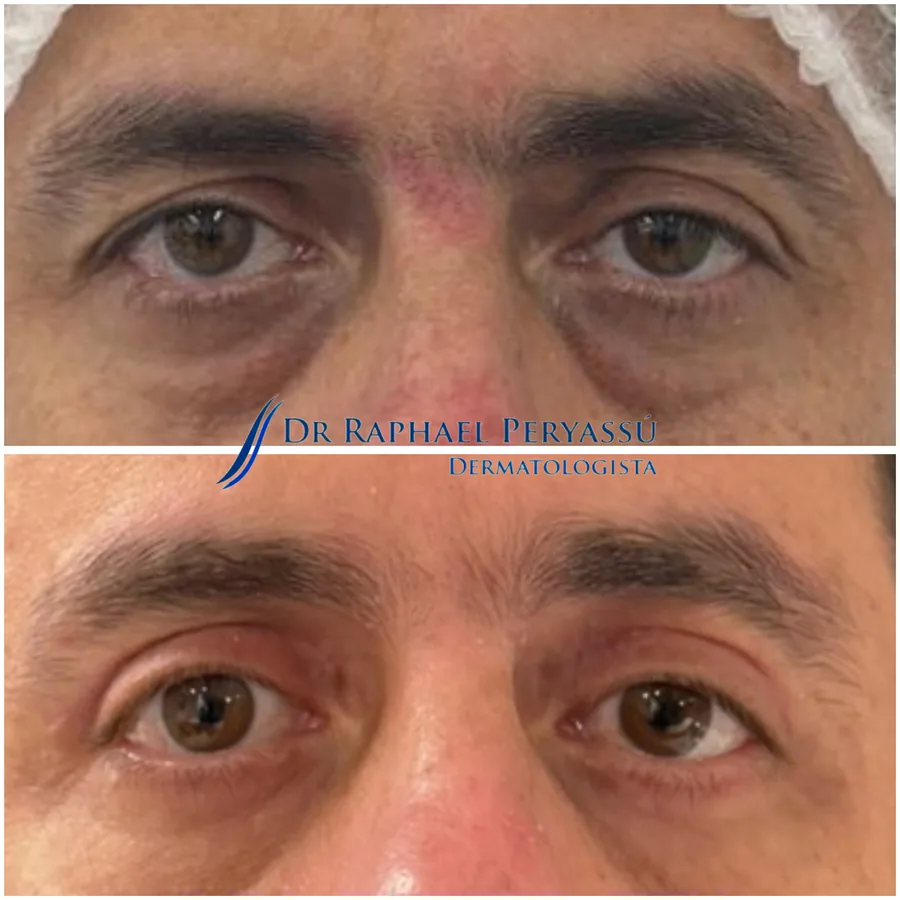 Blefaroplastia antes e depois – Caso 3