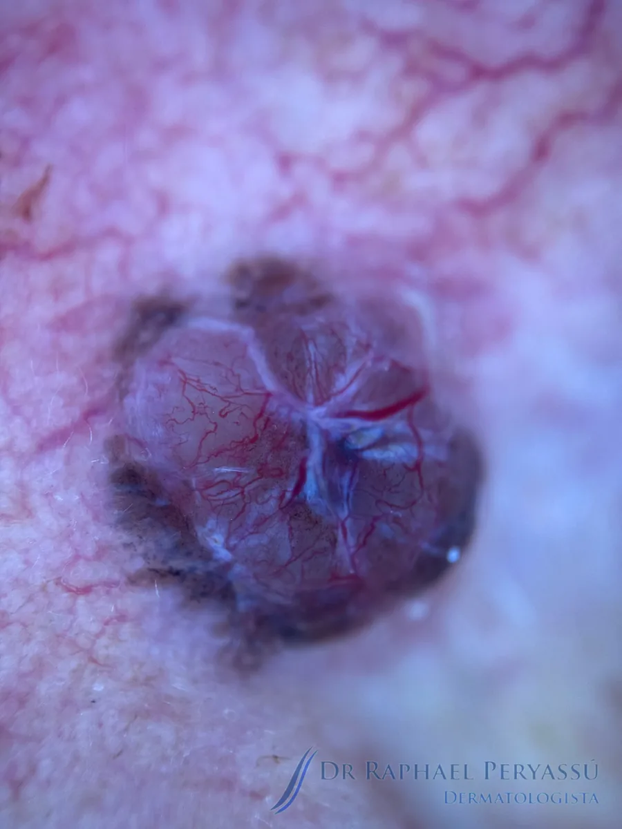 Dermatoscopia de Carcinoma Basocelular