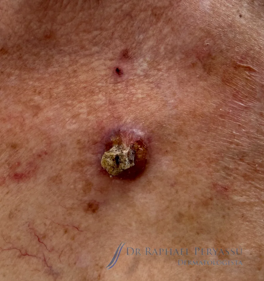 Carcinoma Espinocelular