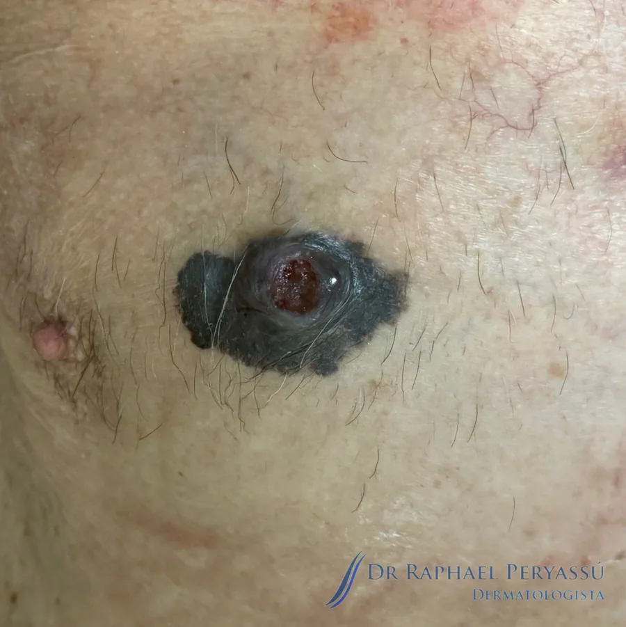 Melanoma