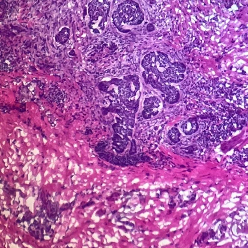 Análise microscópica de tecido (lâmina histológica) durante a Cirurgia de Mohs
